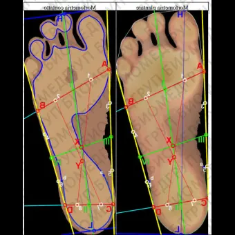 Компьютеризованный подоскоп 3D PODOSCANALYZER