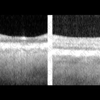 Офтальмоскоп ОКТ IOLMaster 700