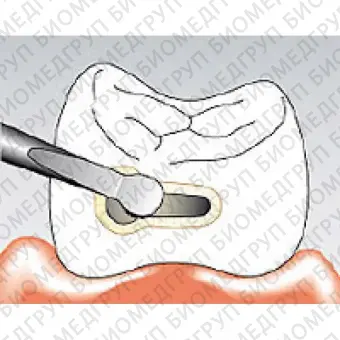 Sonicflex micro 31 A  насадка для минимально инвазивной терапии кариеса с алмазным покрытием, малая полусфера, дистальная