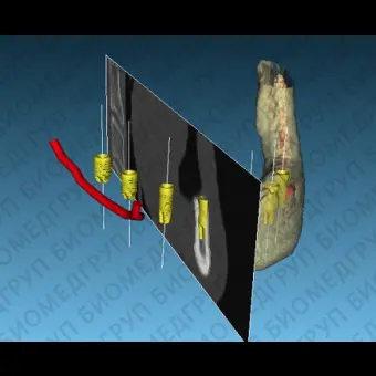 Программное обеспечение для стоматологической имплантологии BTI Scan 3