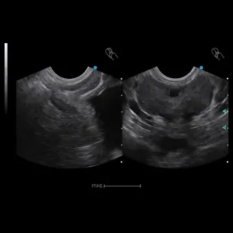 Ультразвуковой сканер переносной, с тележкой Apogee 2300 Urology