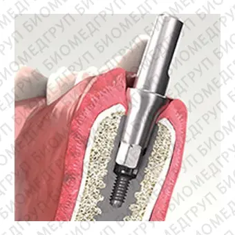 Конический зубной имплантат Implant 3.0