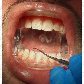 Прибор для открывания рта для стоматологии S151