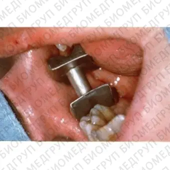 Прибор для открывания рта для стоматологии 070300