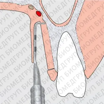 Двойной стоматологический бистури PALATAL
