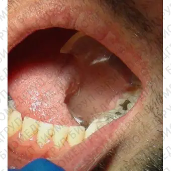 Прибор для открывания рта для стоматологии S151
