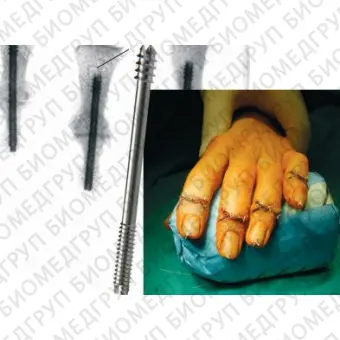Артродезный винт для артродеза межфалангового сустава кисти руки SCRU2