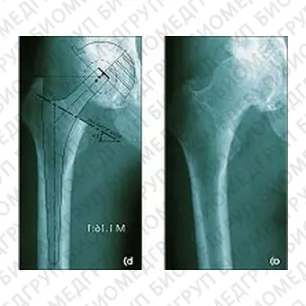 Протез бедренной кости без цемента VektorTITAN