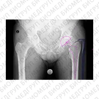 Программное обеспечение для хирургии тазобедренного сустава Hip Arthroplasty