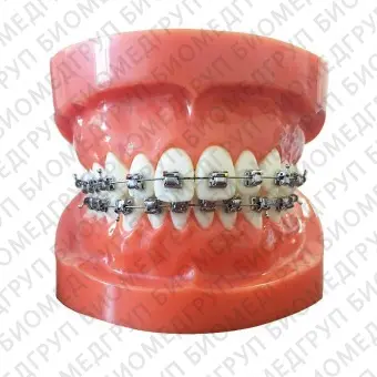 Ортодонтические скобы из металла