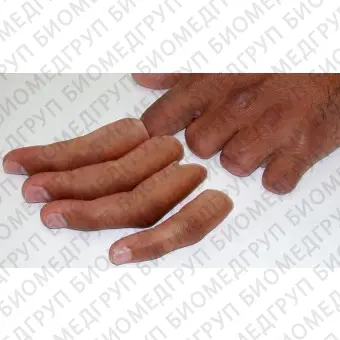 Эстетический протез пальца