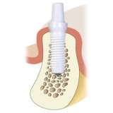Цилиндрический зубной имплантат Z5m