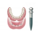Конический зубной имплантат ATLAS
