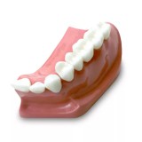 DM23 модель верхней челюсти для демонстрации установки зубного моста