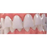 Зубная форма для выравнивания зубов Invisalign
